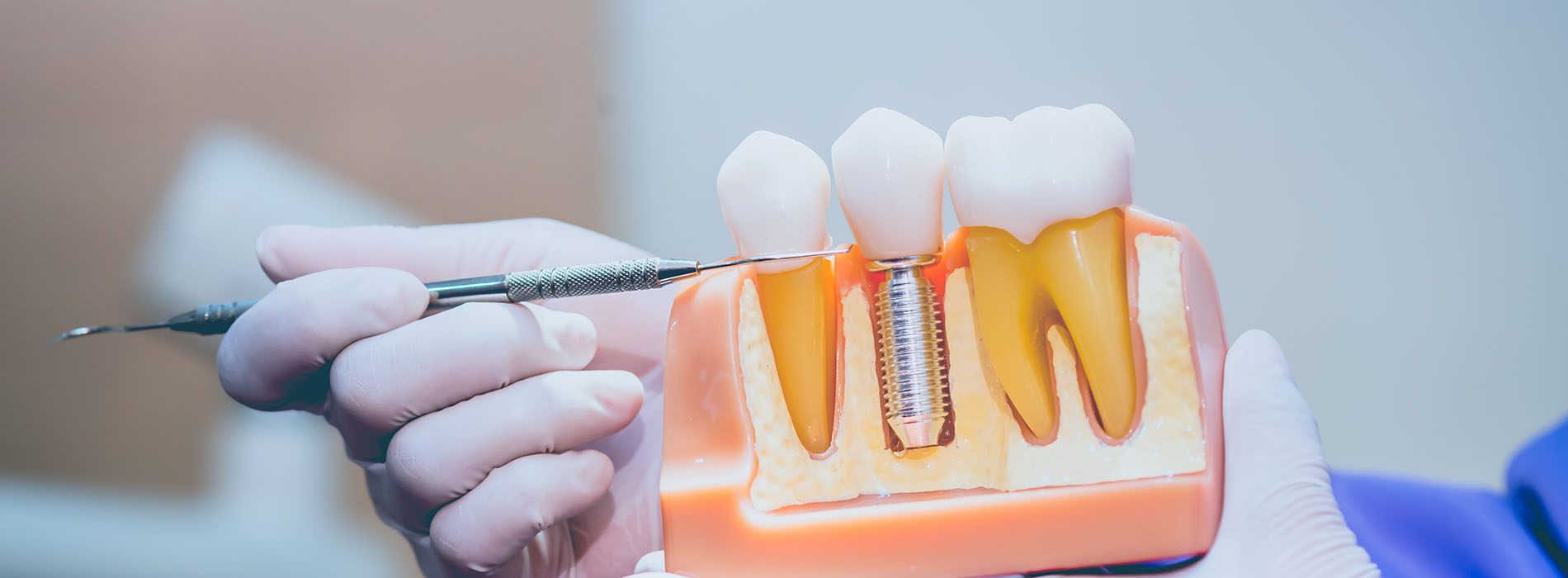 Douglas F. Geiger, DMD, PLLC | Full Mouth Reconstruction, Digital Impressions and Dental Fillings