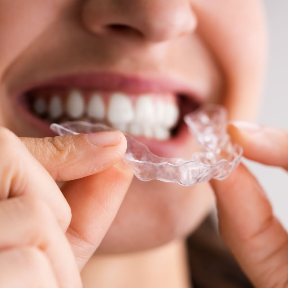 An individual putting on their clear aligners